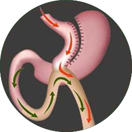 Laproscopic Gastric Bypass surgery